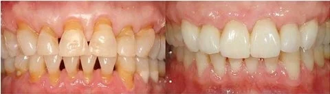 Antes y después