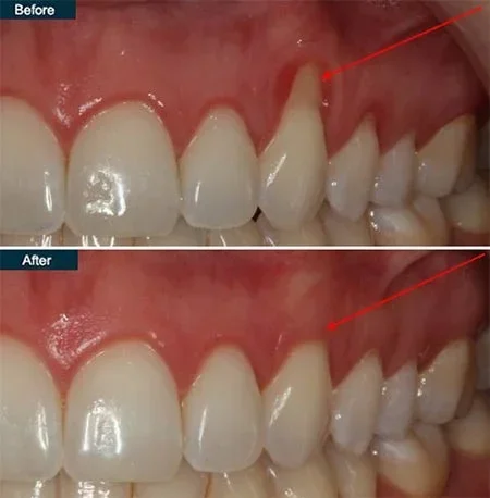Antes y después