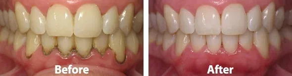 Antes y después