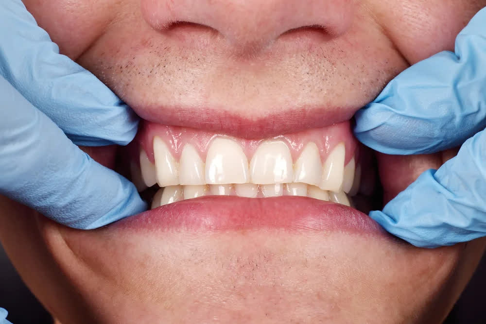 Revisión de las encías y la línea gingival