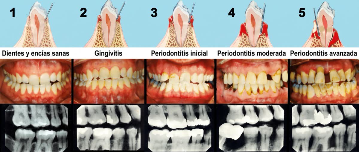 Etapas de la enfermedad de las encías, de sanas a periodontitis avanzada