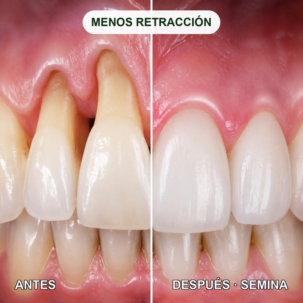 Antes y despues: retraccion de encias