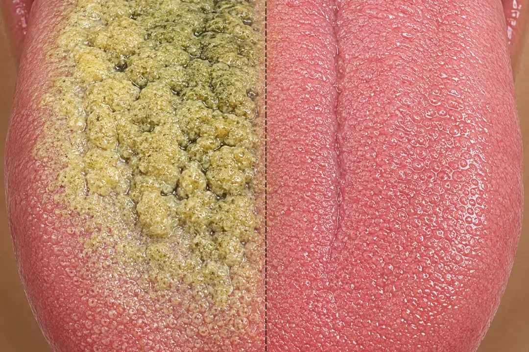 Lengua con colonia de bacterias vs lengua limpia